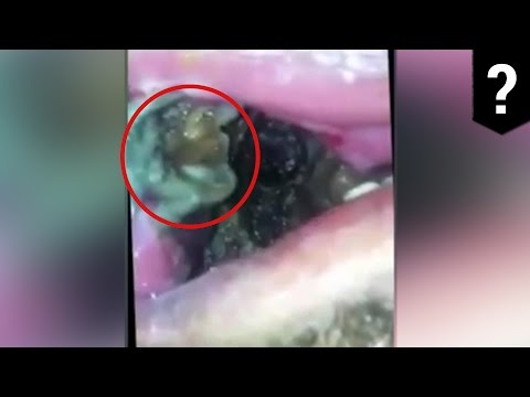 #YouNastyMFSeries Maggots in mouth: Man’s mouth contains horrific, black, wriggling mass
